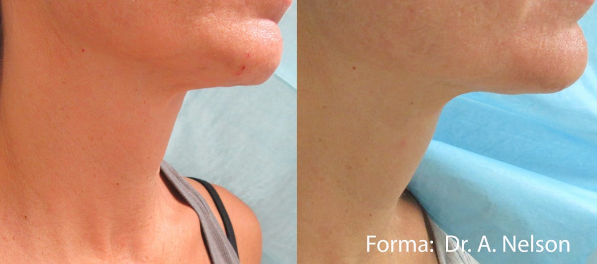 Forma Skin Tightening Before & After Gallery - Patient 128405938 - Image 2