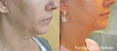 Forma Skin Tightening Before & After Gallery - Patient 128405939 - Image 1