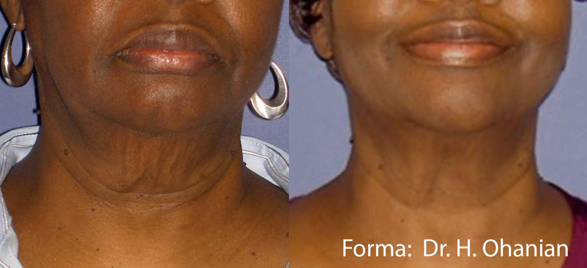 Forma Skin Tightening Before & After Gallery - Patient 128405940 - Image 1