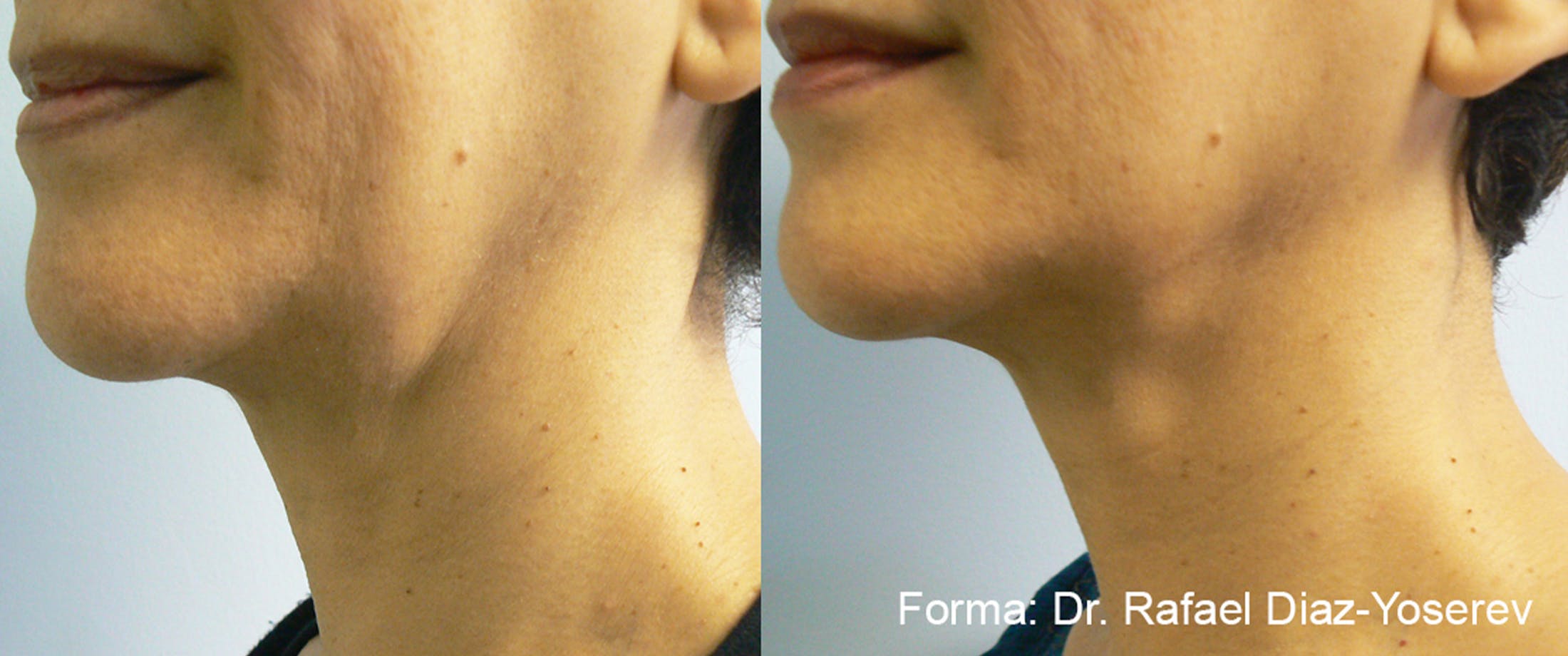 Forma Skin Tightening Before & After Gallery - Patient 128405941 - Image 1