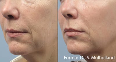 Forma Skin Tightening Before & After Gallery - Patient 128405942 - Image 1