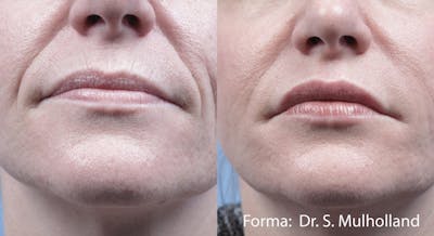 Forma Skin Tightening Before & After Gallery - Patient 128405943 - Image 1