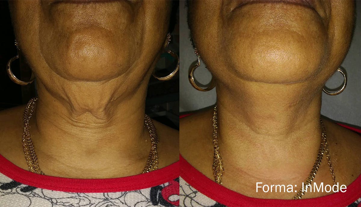 Forma Skin Tightening Before & After Gallery - Patient 128405945 - Image 1