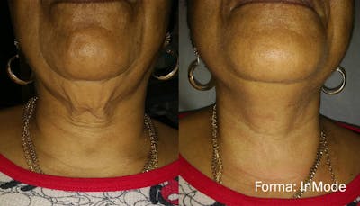 Forma Skin Tightening Before & After Gallery - Patient 128405945 - Image 1