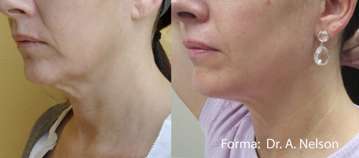 Forma Skin Tightening Before & After Gallery - Patient 128405946 - Image 1