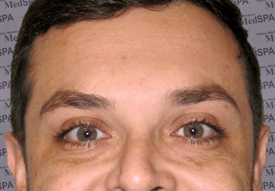 BOTOX Before & After Gallery - Patient 132985700 - Image 2