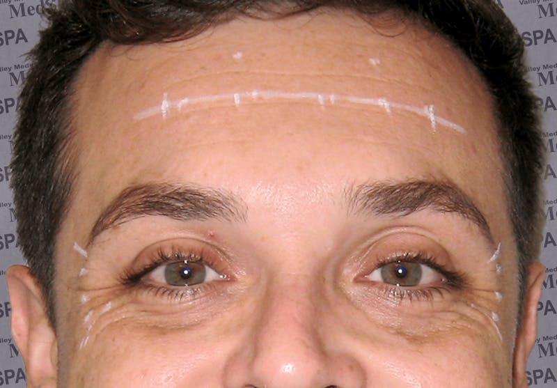BOTOX Before & After Gallery - Patient 132985700 - Image 1