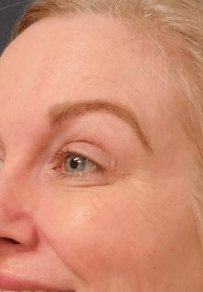 BOTOX Before & After Gallery - Patient 132985701 - Image 2