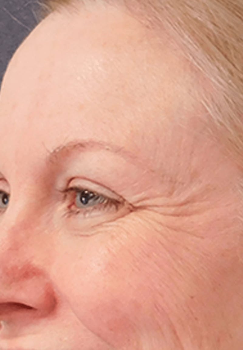 BOTOX Before & After Gallery - Patient 132985701 - Image 1