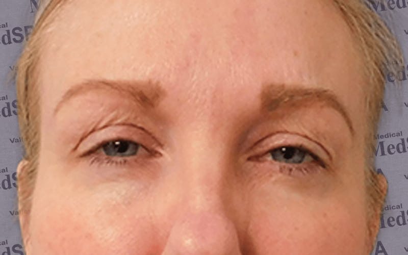 BOTOX Before & After Gallery - Patient 132985701 - Image 4