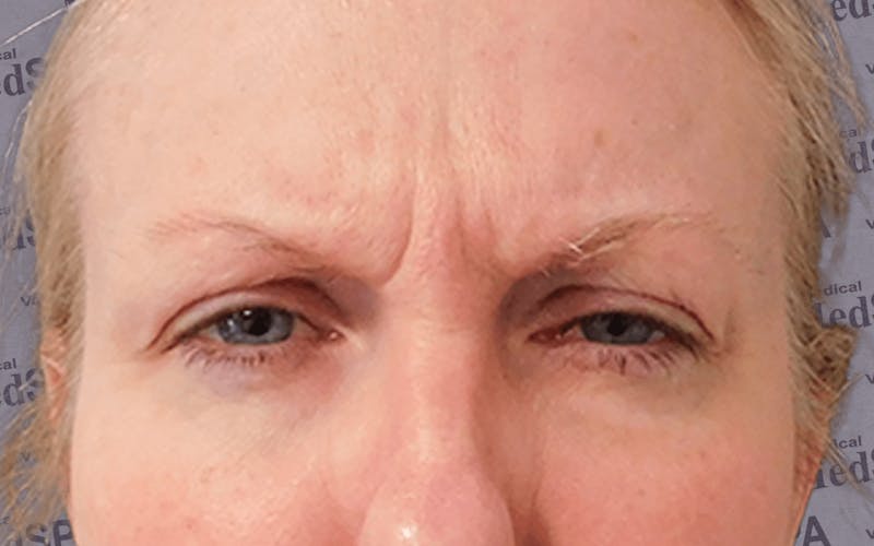 BOTOX Before & After Gallery - Patient 132985701 - Image 3