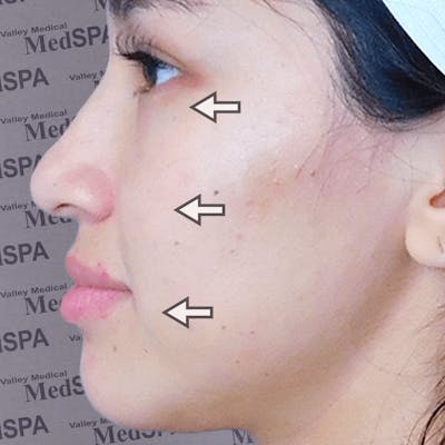 Fillers Before & After Gallery - Patient 132985782 - Image 2