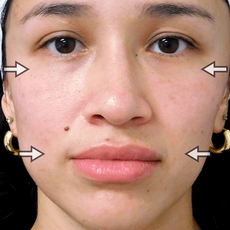 Fillers Before & After Gallery - Patient 132985782 - Image 6