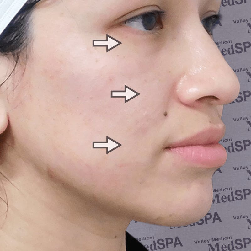 Fillers Before & After Gallery - Patient 132985782 - Image 9
