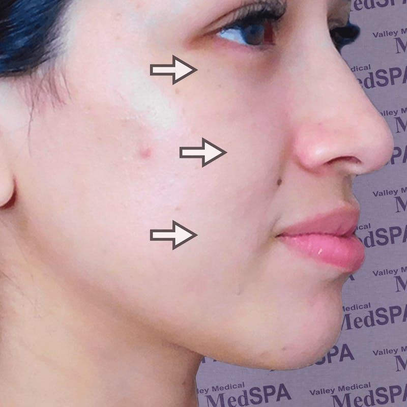 Fillers Before & After Gallery - Patient 132985782 - Image 10