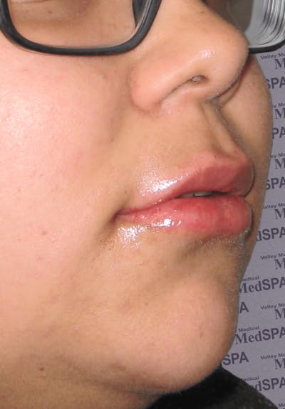 Fillers Before & After Gallery - Patient 132985783 - Image 2