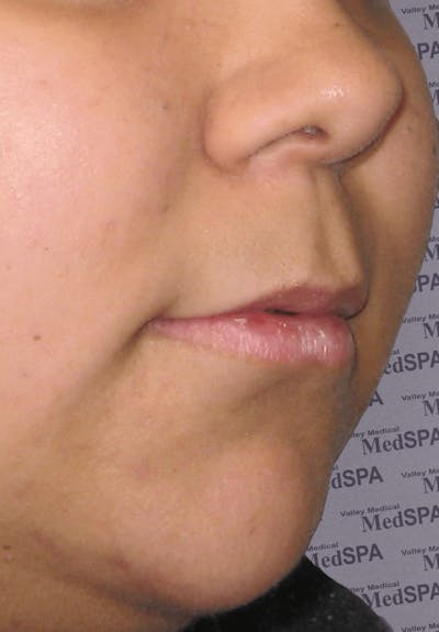 Fillers Before & After Gallery - Patient 132985783 - Image 1