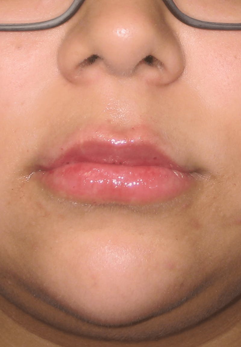 Fillers Before & After Gallery - Patient 132985783 - Image 4