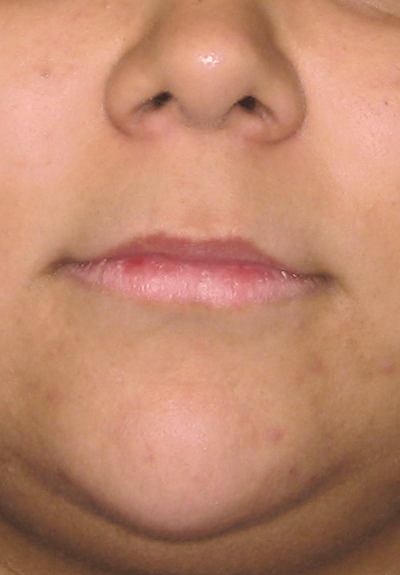 Fillers Before & After Gallery - Patient 132985783 - Image 3