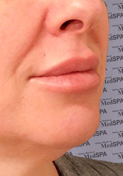 Fillers Before & After Gallery - Patient 132985784 - Image 2