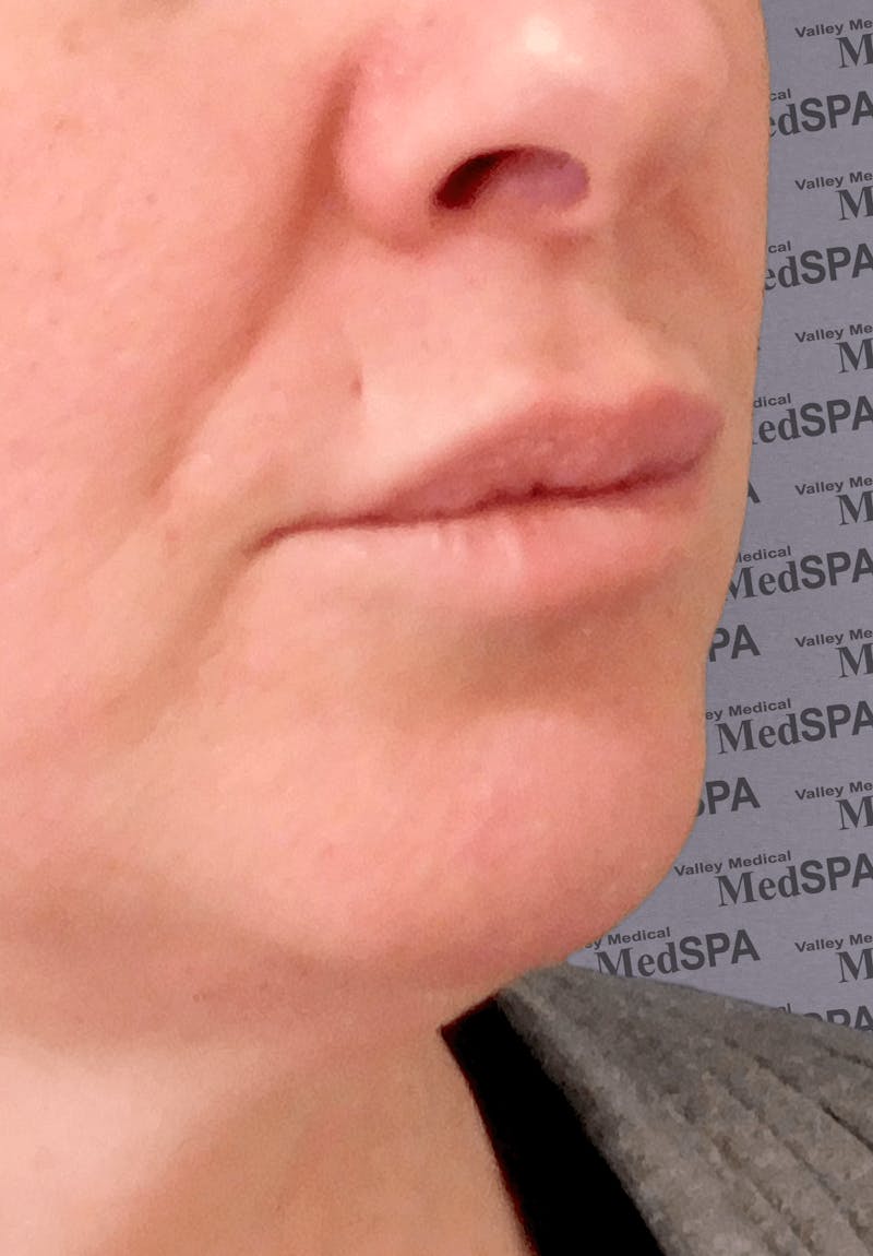 Fillers Before & After Gallery - Patient 132985784 - Image 1