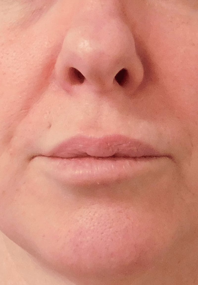 Fillers Before & After Gallery - Patient 132985784 - Image 3