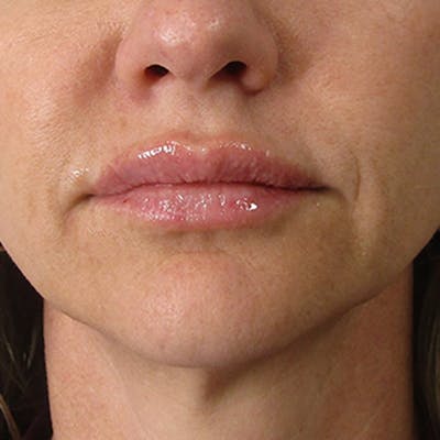 Fillers Before & After Gallery - Patient 132985785 - Image 2