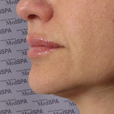 Fillers Before & After Gallery - Patient 132985785 - Image 1