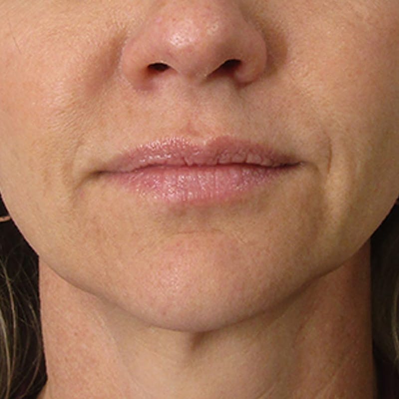 Fillers Before & After Gallery - Patient 132985785 - Image 4