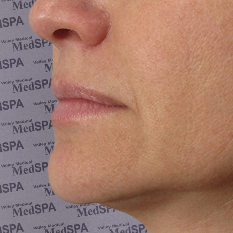 Fillers Before & After Gallery - Patient 132985785 - Image 3