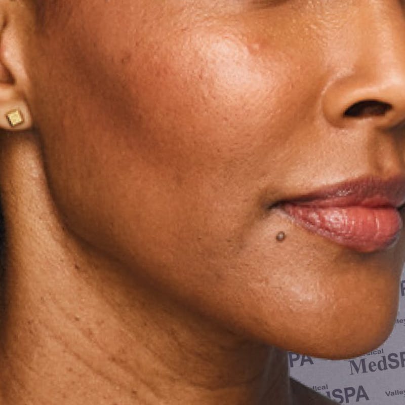 Fillers Before & After Gallery - Patient 132985786 - Image 2