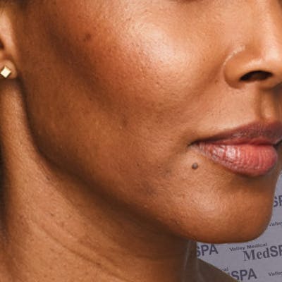 Fillers Before & After Gallery - Patient 132985786 - Image 1