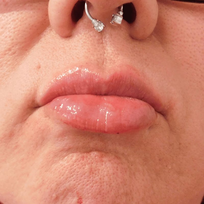 Fillers Before & After Gallery - Patient 132985787 - Image 2