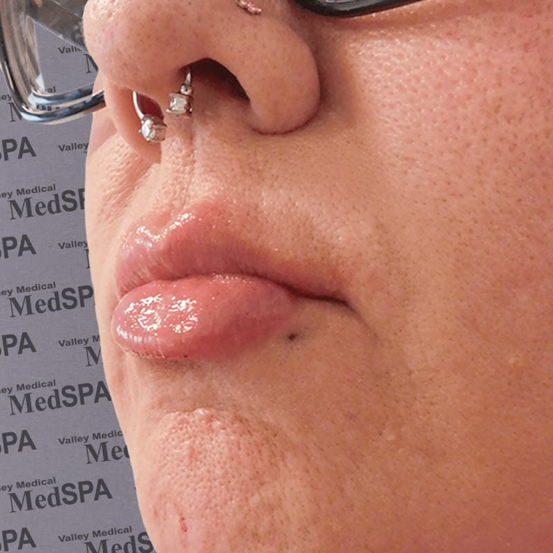 Fillers Before & After Gallery - Patient 132985787 - Image 4