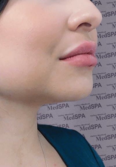Fillers Before & After Gallery - Patient 132985788 - Image 2