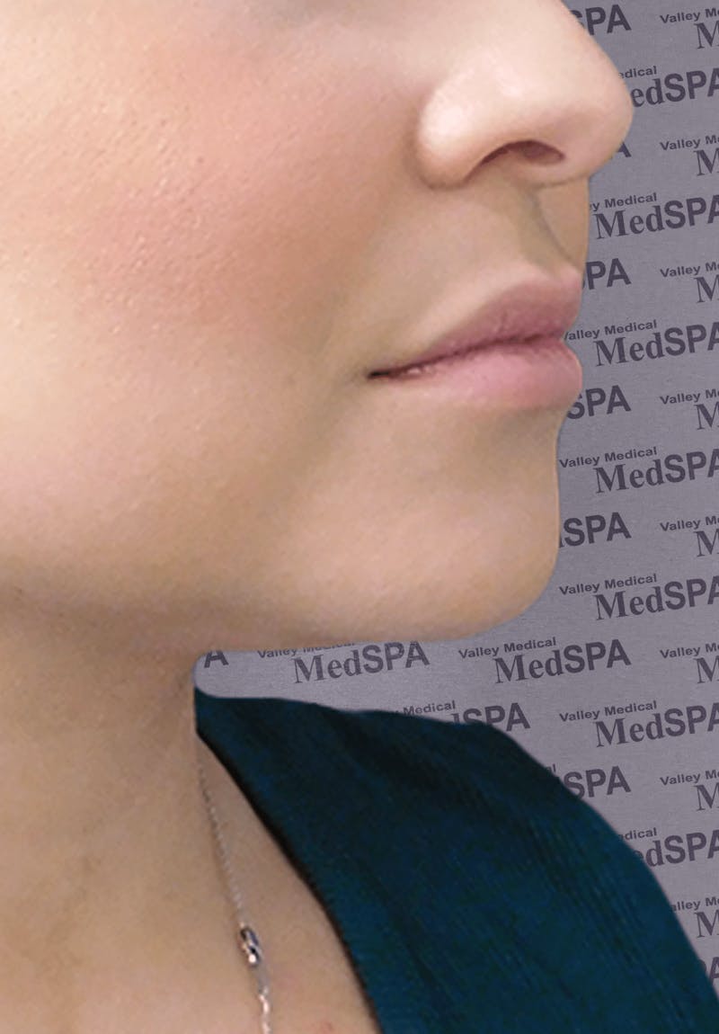 Fillers Before & After Gallery - Patient 132985788 - Image 1