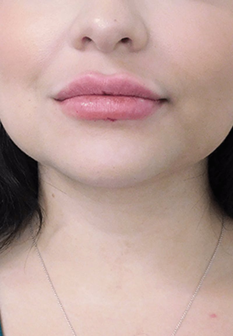 Fillers Before & After Gallery - Patient 132985788 - Image 4
