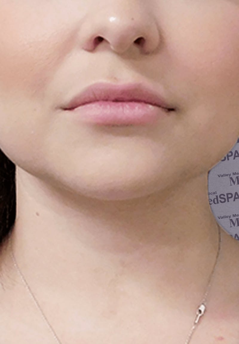 Fillers Before & After Gallery - Patient 132985788 - Image 3