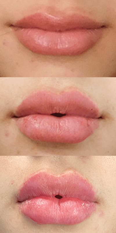 Fillers Before & After Gallery - Patient 132985789 - Image 1
