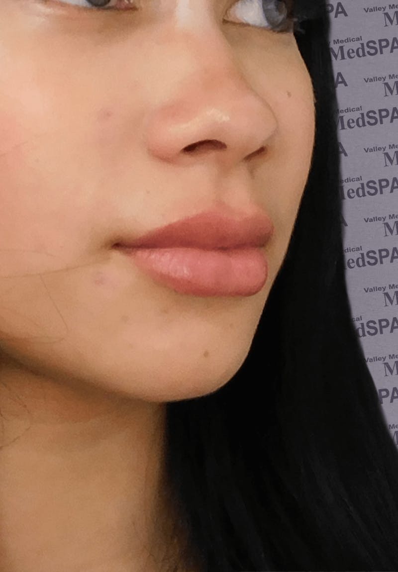 Fillers Before & After Gallery - Patient 132985789 - Image 6