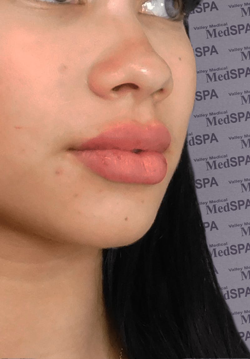 Fillers Before & After Gallery - Patient 132985789 - Image 5