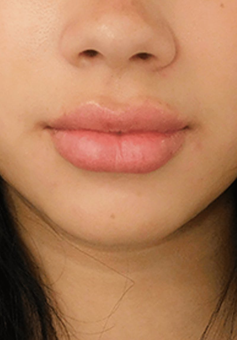 Fillers Before & After Gallery - Patient 132985789 - Image 7