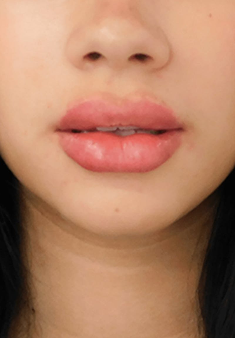 Fillers Before & After Gallery - Patient 132985789 - Image 9