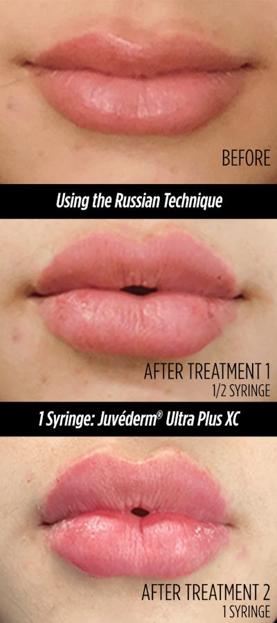 Fillers Before & After Gallery - Patient 132985789 - Image 2