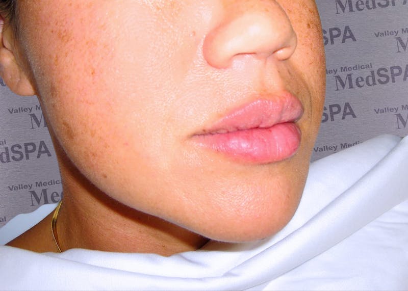 Fillers Before & After Gallery - Patient 132985827 - Image 2