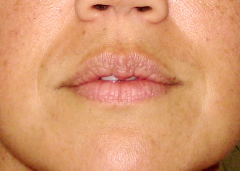 Fillers Before & After Gallery - Patient 132985827 - Image 3
