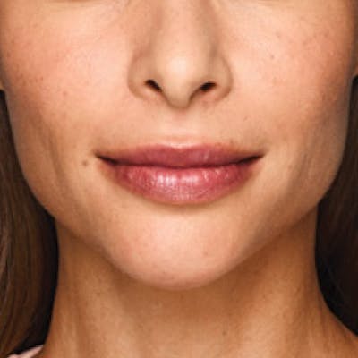 Fillers Before & After Gallery - Patient 132985828 - Image 2