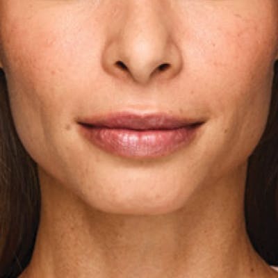 Fillers Before & After Gallery - Patient 132985828 - Image 1