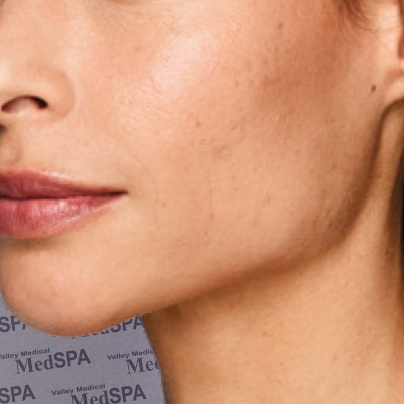Fillers Before & After Gallery - Patient 132985828 - Image 4