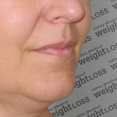 Fillers Before & After Gallery - Patient 132985829 - Image 1